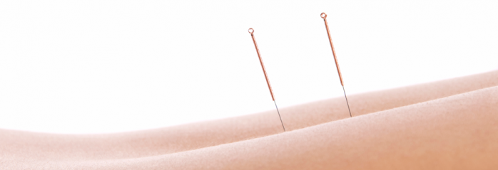 acupuncture needles on woman's leg
