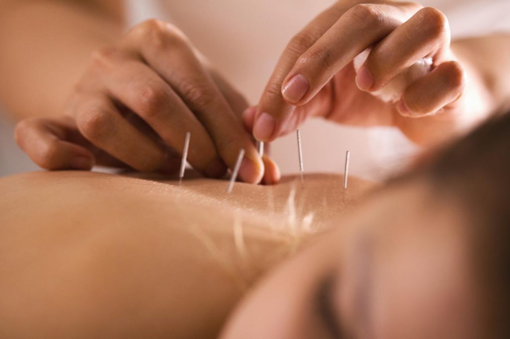 The Benefits of Acupuncture